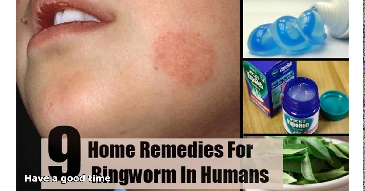 Home Remedies For Ringworm TOP 5 DIY