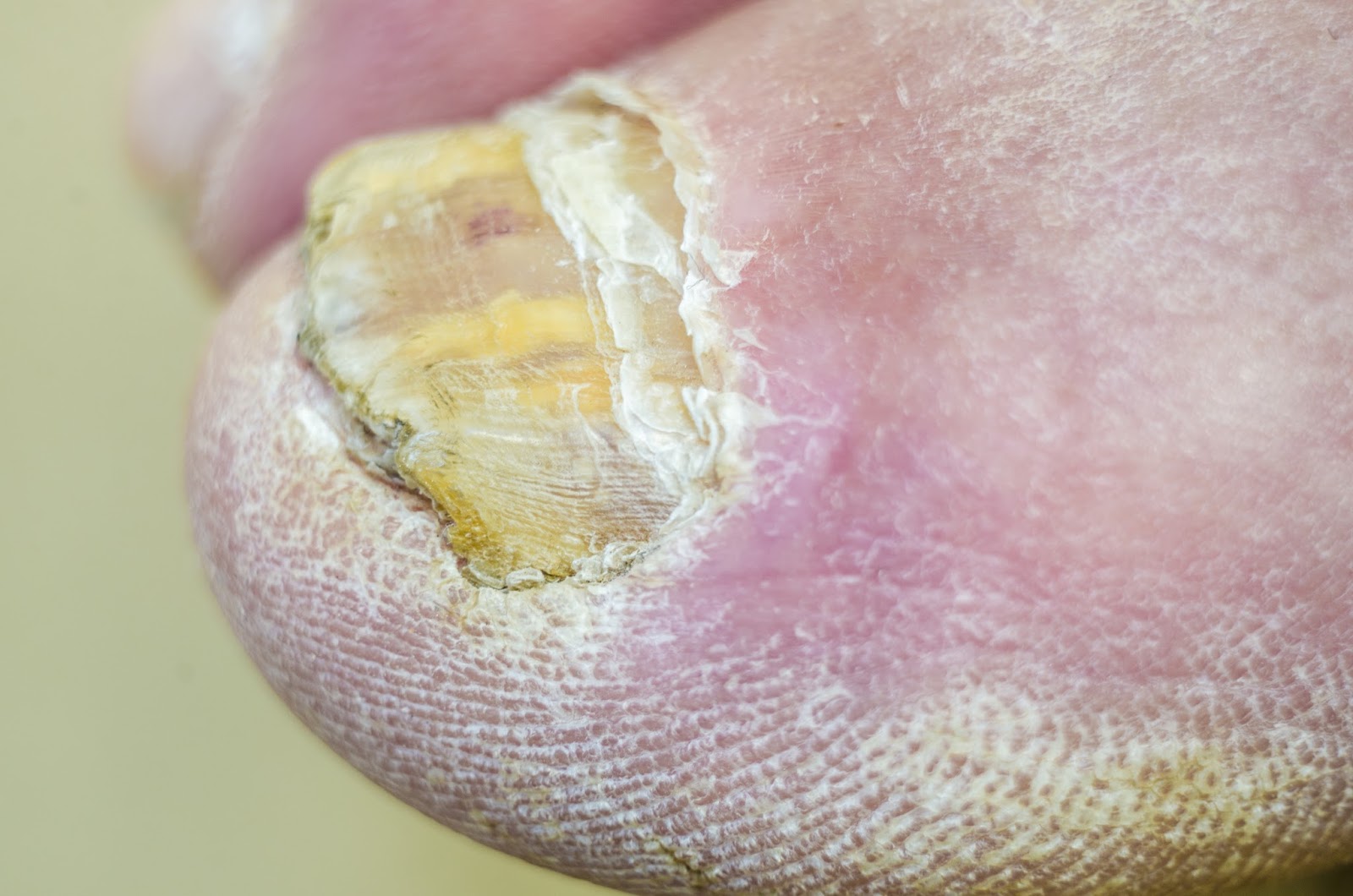 Understanding Fungal Nail Infections and Best Treatment Options