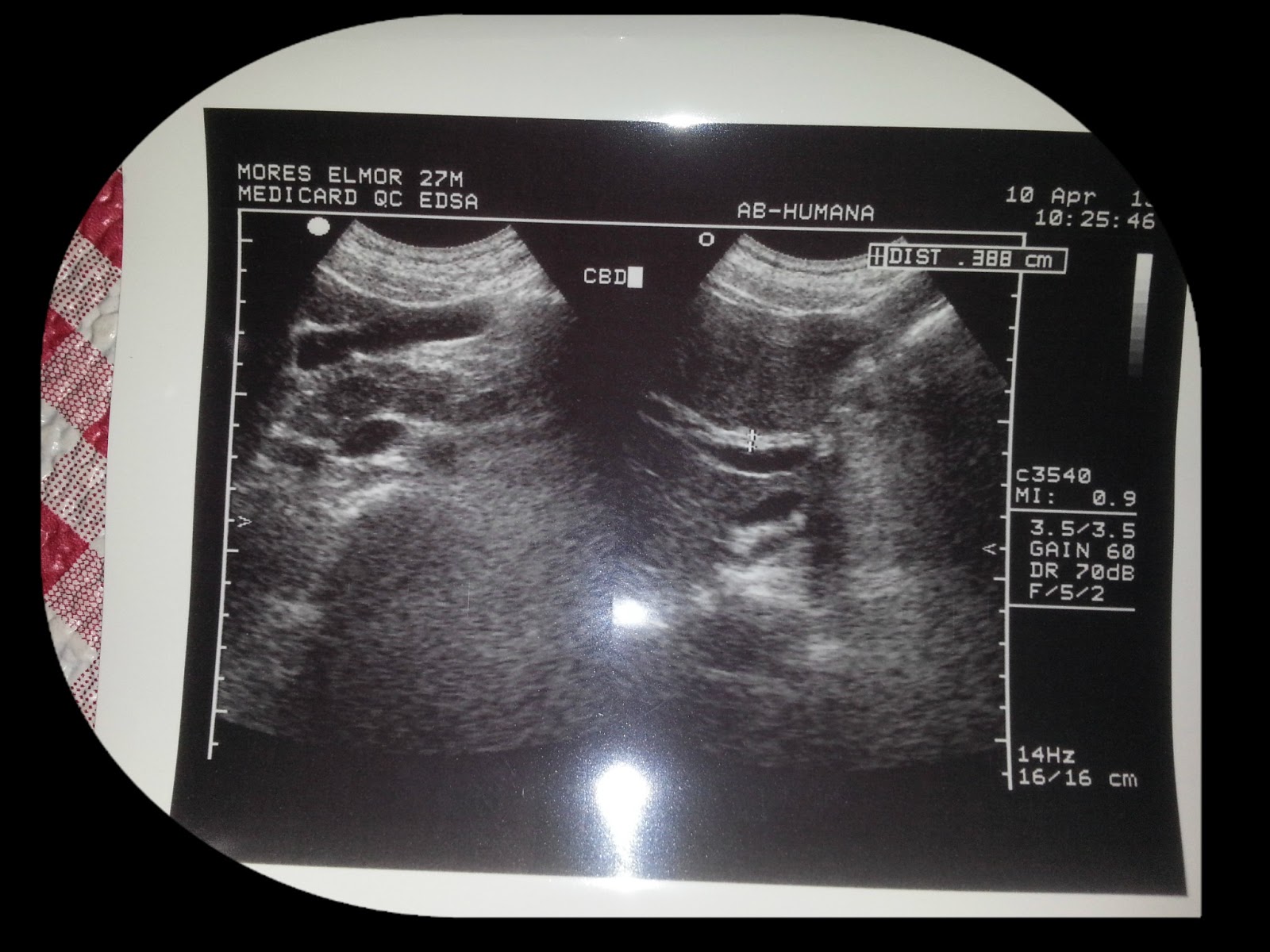 POTTERmoi: ULTRASOUND RESULT ON WHOLE ABDOMEN