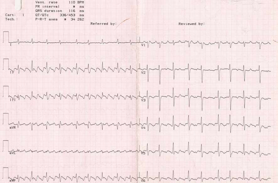 Описание экг фибрилляция предсердий тахисистолическая форма. Фибрилляция предсердий заключение. Фибрилляция предсердий заключение. Холтер экг трепетание предсердий. Фибрилляция и мерцание предсердий.