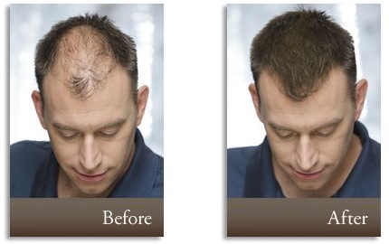 Best Hair Building Fibers For Thinning Hair Cover Hair Loss