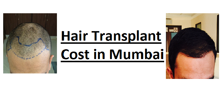 Hair Transplant Cost in India Mumbai