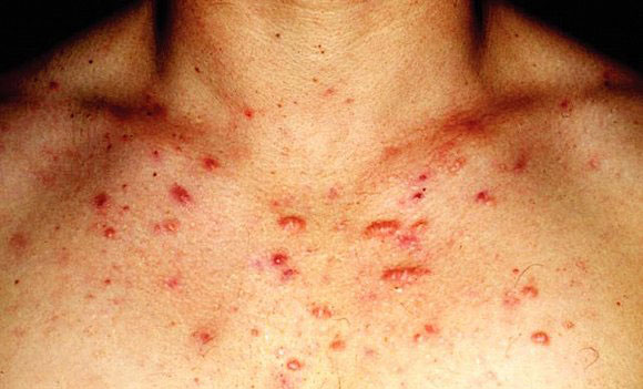 ways to get rid of chest acne