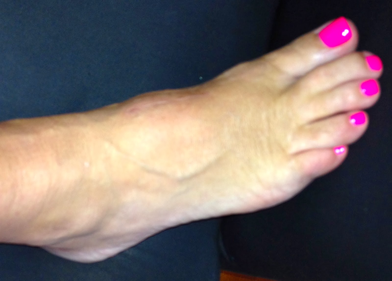 After LisFranc Surgery 22 weeks post lisfranc surgery