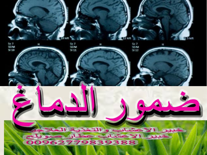 ضمور الدماغ ضمور المخ ضمور المخ عند الأطفال