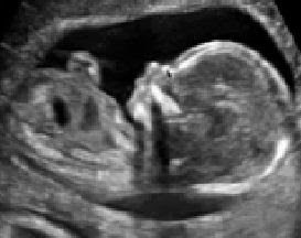 12 haftalık gebelik ultrason görüntüleri