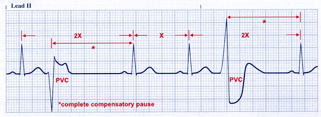 premature ventricular contraction pvc jantung oke