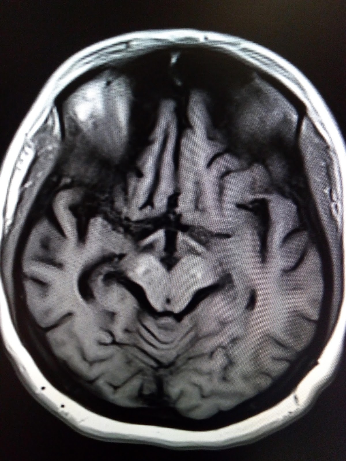 Neurodegeneration with Brain Iron Accumulation (NBIA) MRI Sumer's