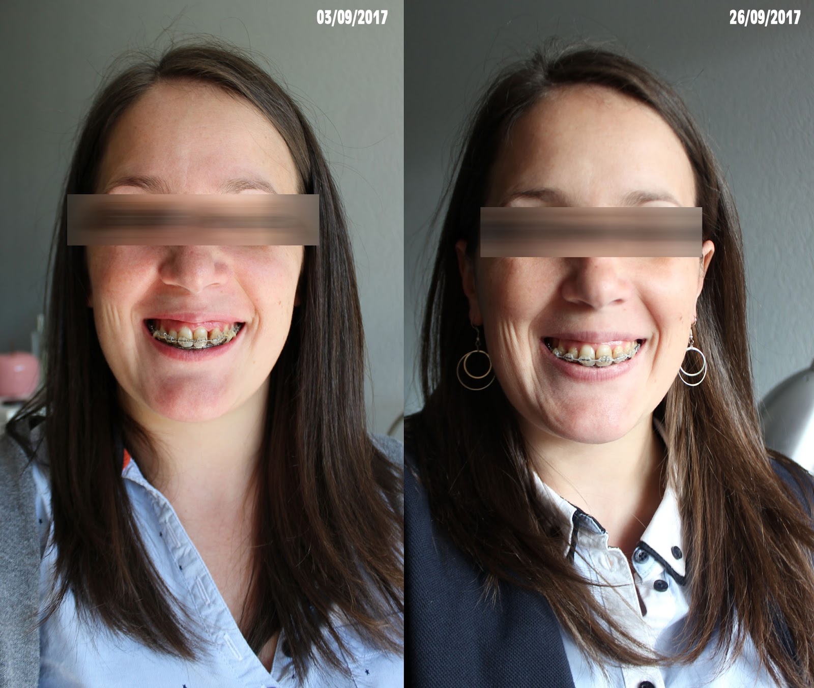 Orthodontie adulte bouche en chantier 17 mois de bagues, et 19 mois postopératoire