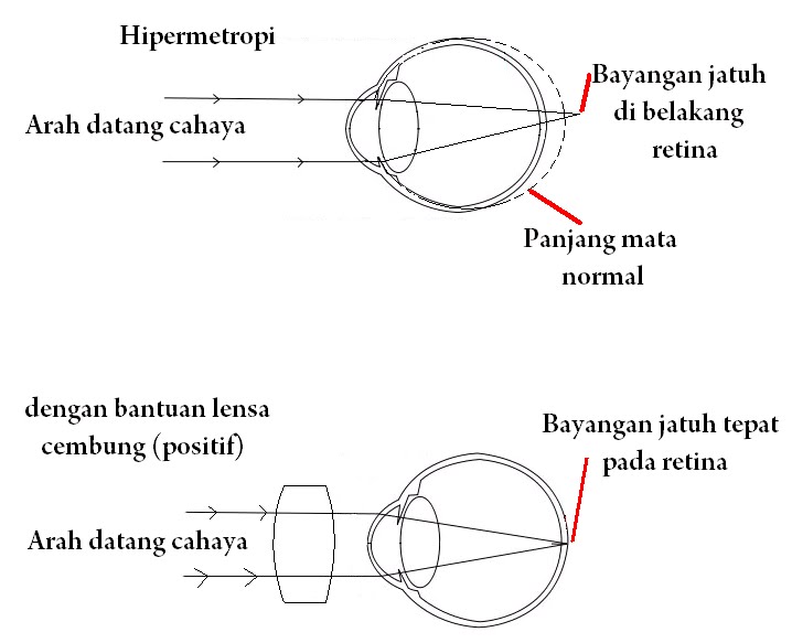 hipermetropie 1-2 grade