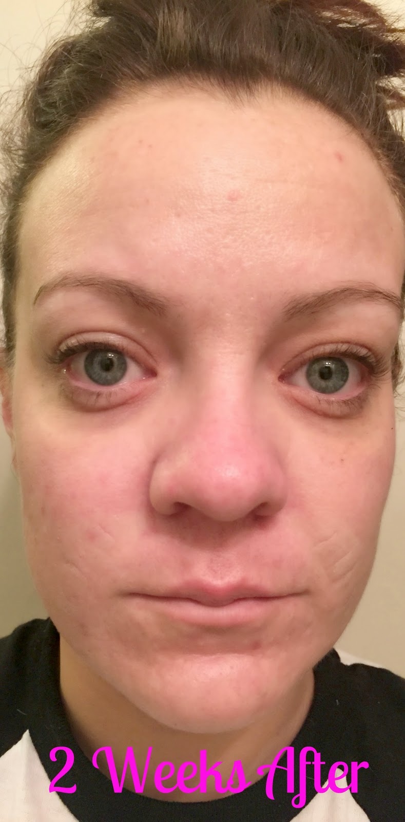 Rodan-and-Fields-Redefine-Regimen-and-Acute-Care-Review, anti-wrinkle 