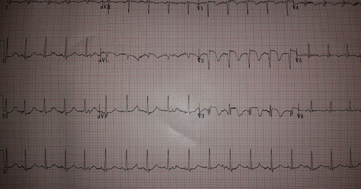 Epigastric Pain After Eating Fatty Food Epigastric Pain After Eating Fatty Food