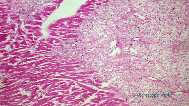 Microscope World image of myocardial infarction under the microscope at 40x.