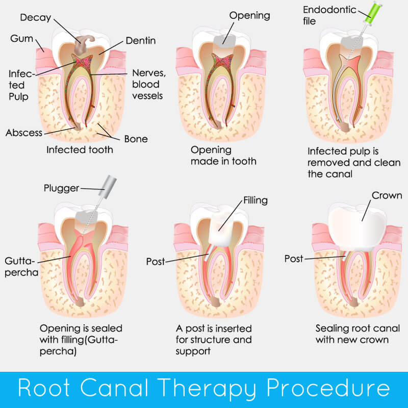 Dentist Best Dental Clinic in Vasundhara Root Canal Treatment Types