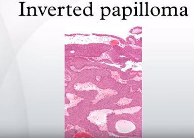 inverted papilloma medical meaning