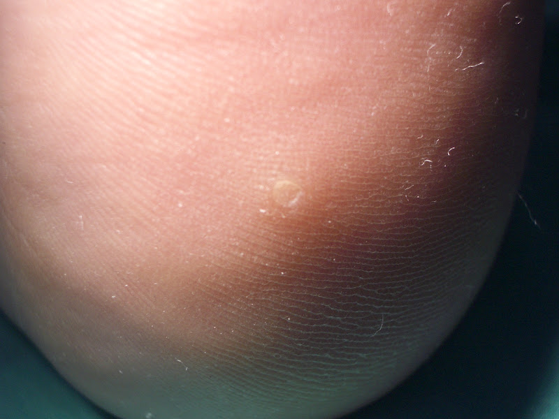 Taller Donde Crece la Vida. Papilomas Plantares Que es? Mi