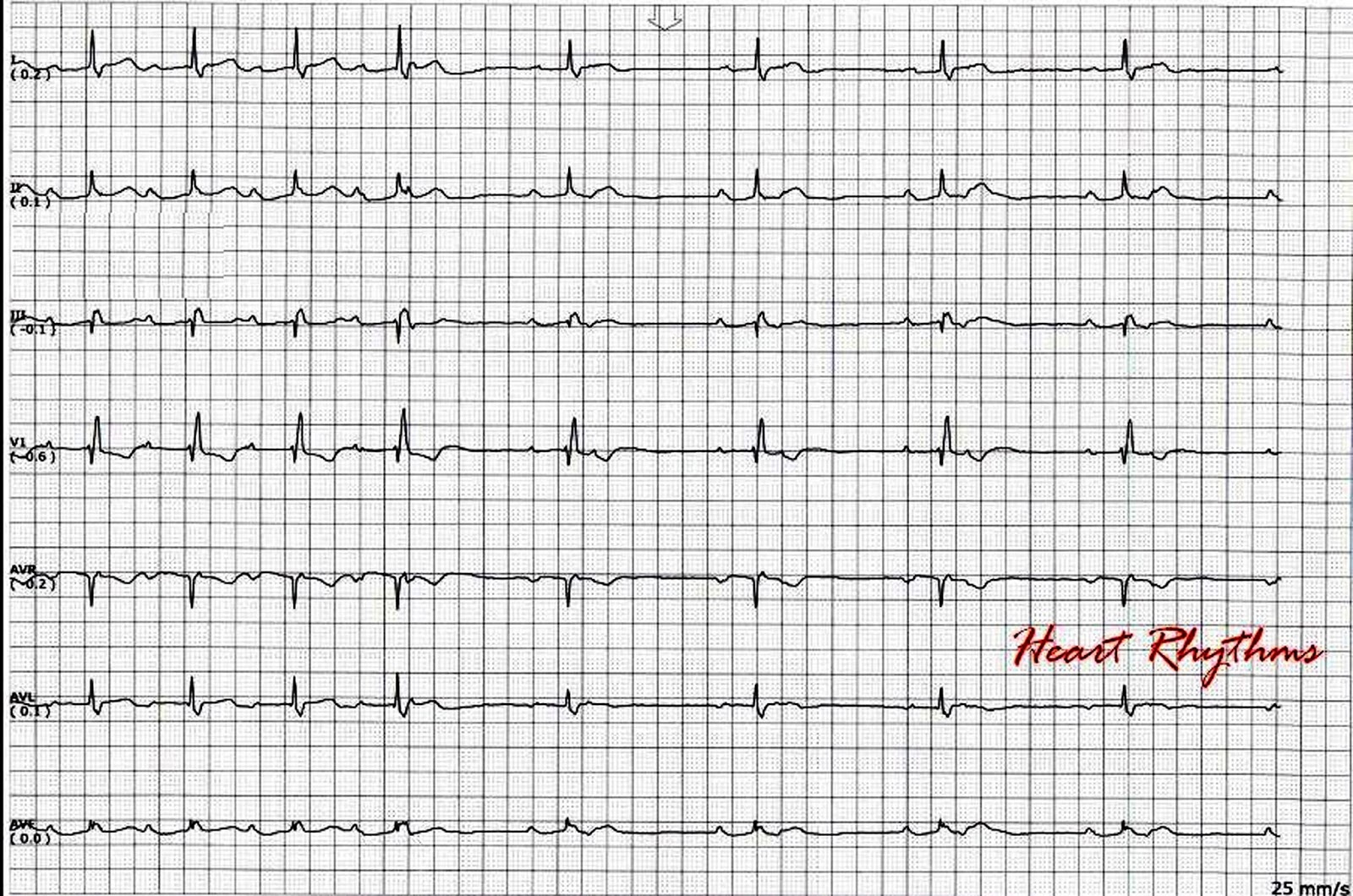ECG Rhythms Second degree AV block type I interrupted by nonconducted