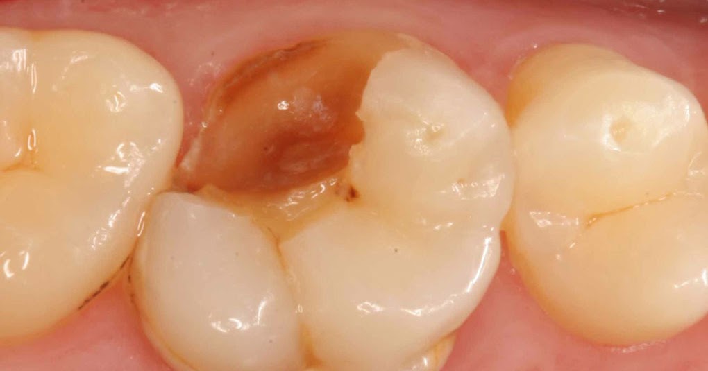 Bellevue Family Dentistry Oral Health Blog Broken tooth while biting