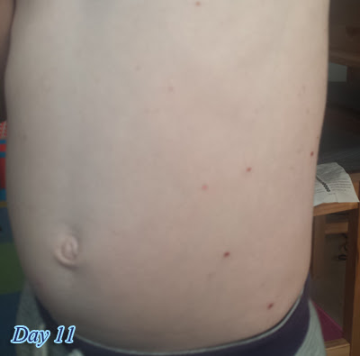 Day11  Photos of Chicken Pox in their various stages