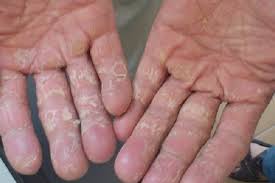 Do sao bị mắc bệnh eczema tổ đỉa Bi%2Blo%2Bda%2Bban%2Btay