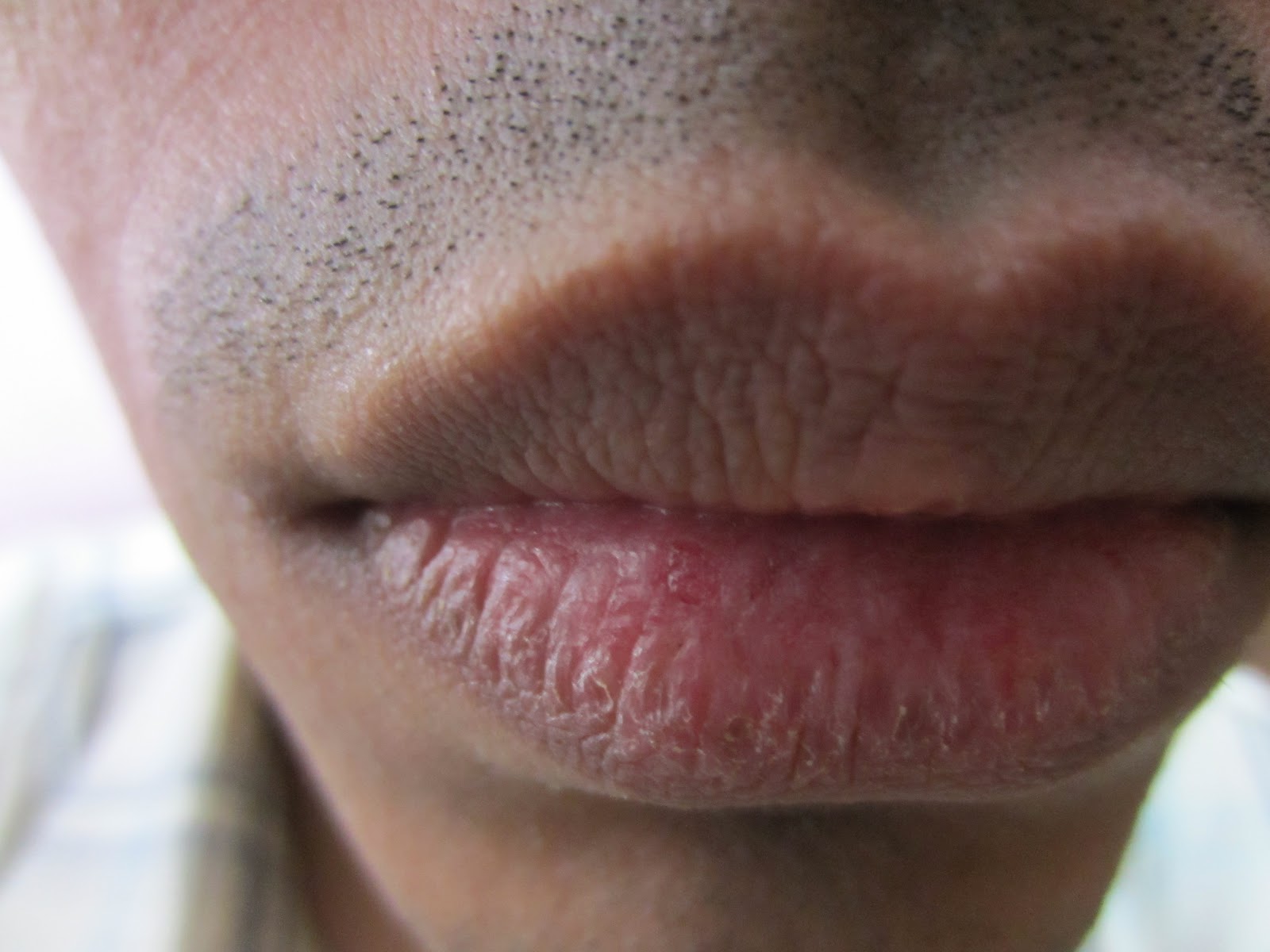 Обветренные губы в домашних условиях