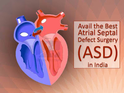 Avail the Best Atrial Septal Defect Surgery in India
