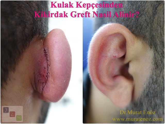 Auricular Cartilage (Auricular Cartilage) Graft in Revision Rhinoplasty - Why auricle cartilage graft is needed in revision rhinoplasty operations? - When auricle cartilage graft is used in revision nose job surgeries? - How to taken the cartilage graft from the auricle (auricular conchal cartilage)? - Recommendations after the cartilage graft taken from the auricle  - Does the shape of the auricle change after the cartilage graft taken from the auricle? - Why is a cartilage graft removed from the auricle? - In which cases is the cartilage graft used from the auricle? - Use of cartilage graft taken from the ear for revision nose aesthetic - Cartilage graft taken from the auricle - What to do after taken of the cartilage graft from the auricle? - Auriculer conchal cartilage - Use of auricular conchal cartilage in nose aesthetic surgery