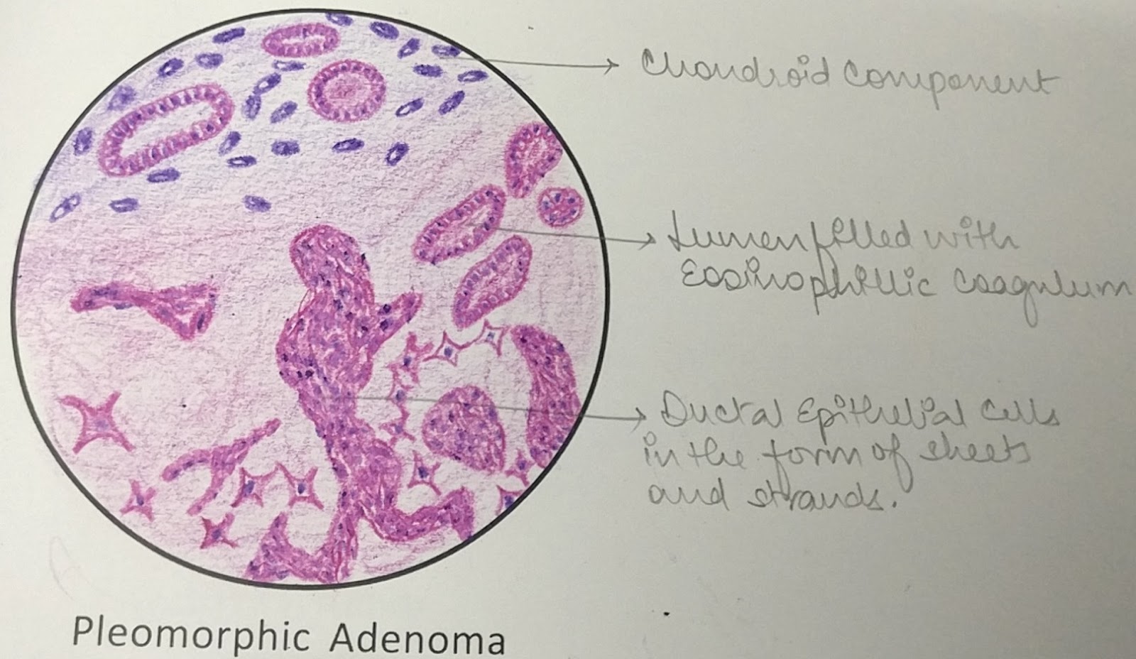 pleomorphic adenoma histology diagram