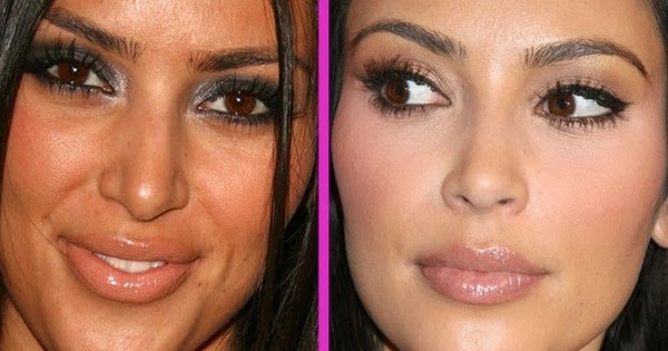 Kozmetik perisii Burun estetiği