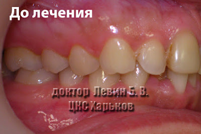 Смыкание зубов по ортогнатическому типу Зубы смыкаются по I классу Энгля