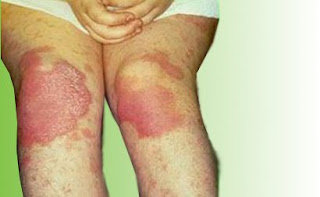 Obat Gatal Eksim Kering Merah di Lutut Kaki