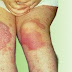 Obat Gatal Eksim Kering Merah di Lutut Kaki