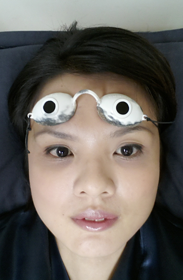 Moments In My Life Permanent Laser Hair Removal Lumenis, Most