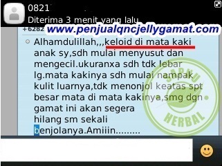 Cara Menghilangkan Keloid di Payudara Secara Alami dan Aman Cara Menghilangkan Keloid di Payudara Secara Alami dan Aman