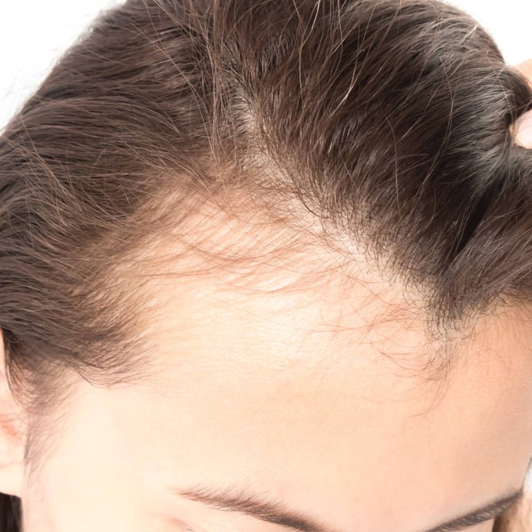 How To Stop My Hair From Falling Out And Thinning Secret Revealed