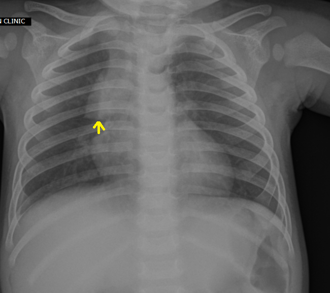 Thymic Sail SignPlain Film Sumer's Radiology Blog