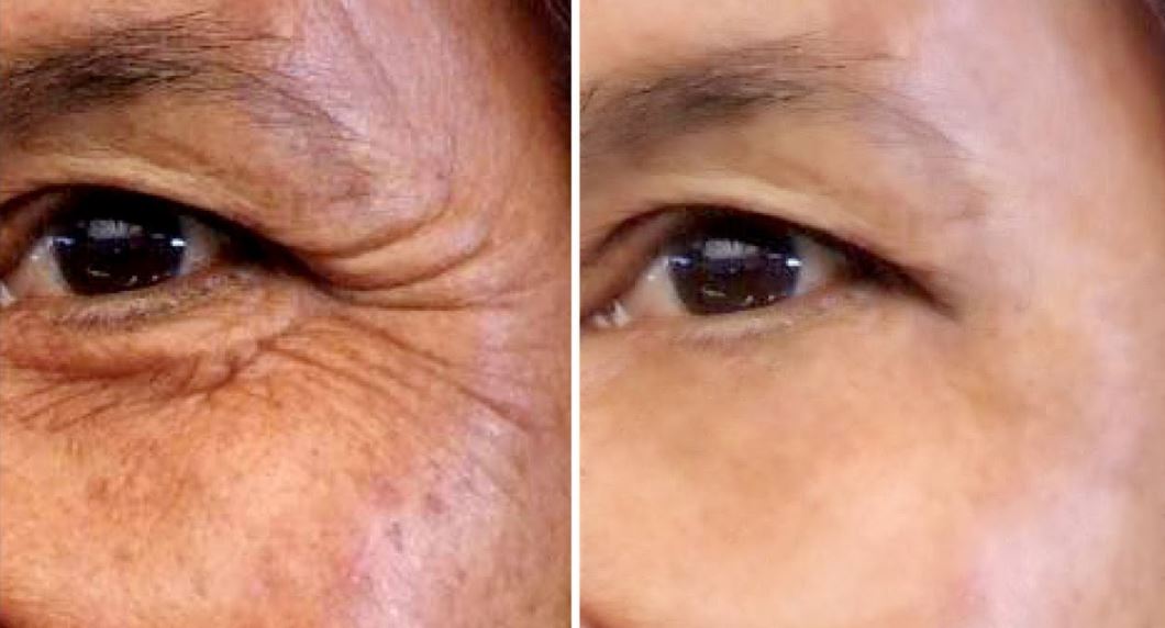 Natural scrub that can remove wrinkles dark spots from your skin in