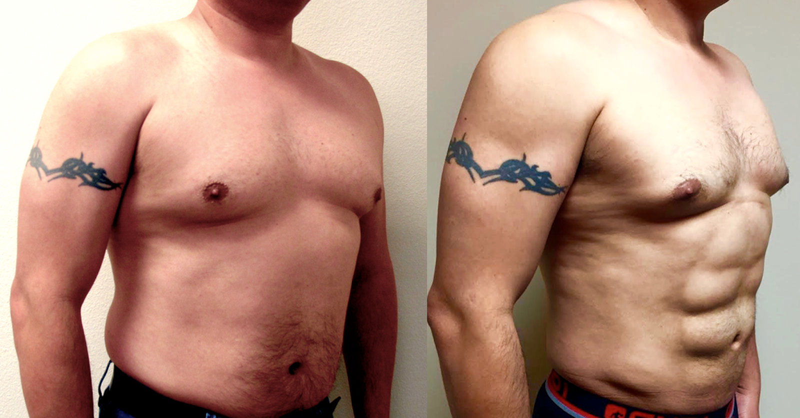 липосакция боков у мужчин. липомоделирование живота мужчине. мужская липосакция живота до и после. пластическая хирургия кубики на животе. липосакция для мужчин.