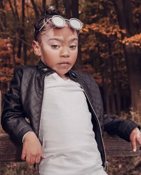 Esta adorable niña con vitiligo está facultando a otros a amarse a sí mismos