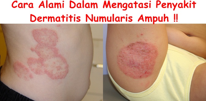 Obat Tradisional Dermatitis Numularis