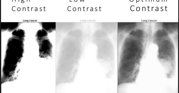 Radiographic Image Quality: Optical Density, Image Detail and ...