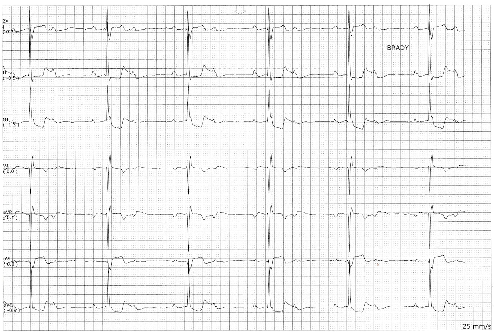 Float Nurse Type I Block With 32 Conduction Changing to a 21 Conduction