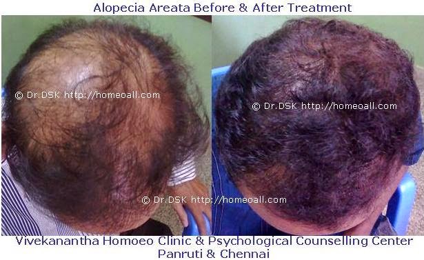  Velachery Alopecia Areata Specialist dr.sendhil kumar panruti Clinic, Chennai, Tamilnadu, India 