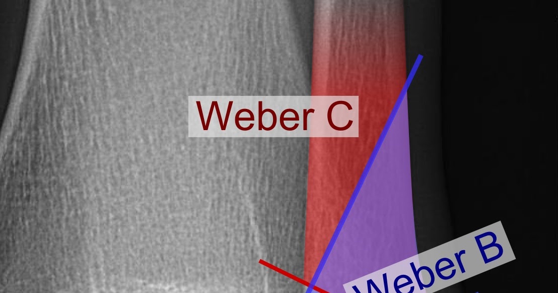 er Ankle Fracture Classification Treatment Surgery
