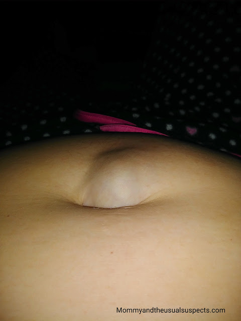Umbilical hernia during pregnancy dangerous