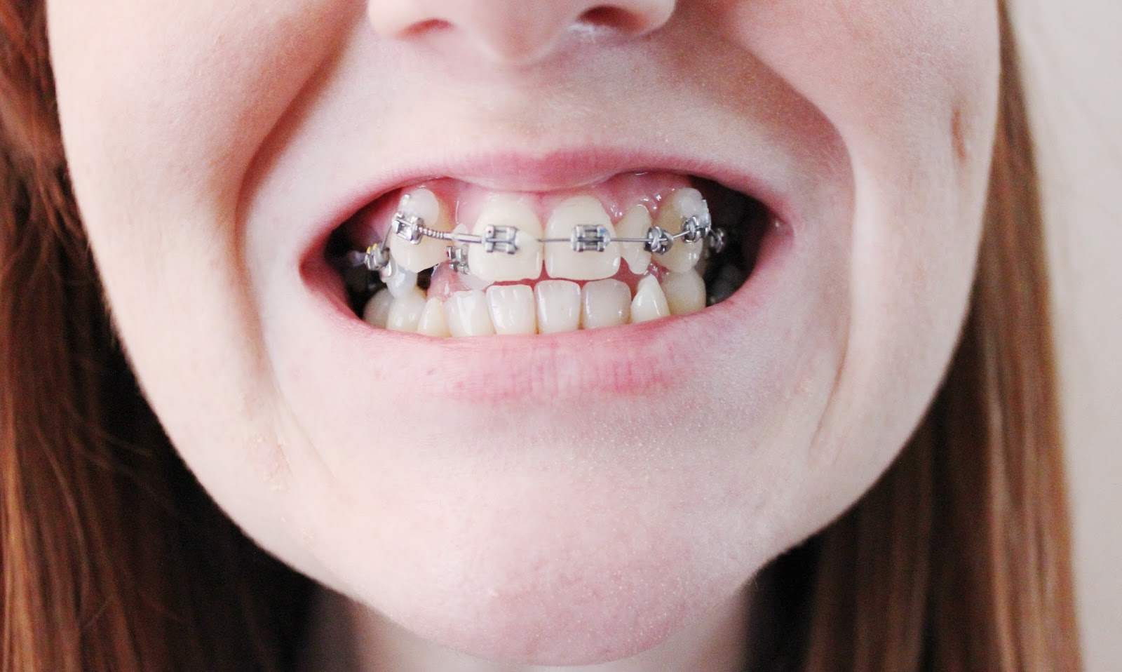 The brace lady My first month in braces