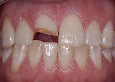 Răng bị gãy một nửa có làm lại được không?