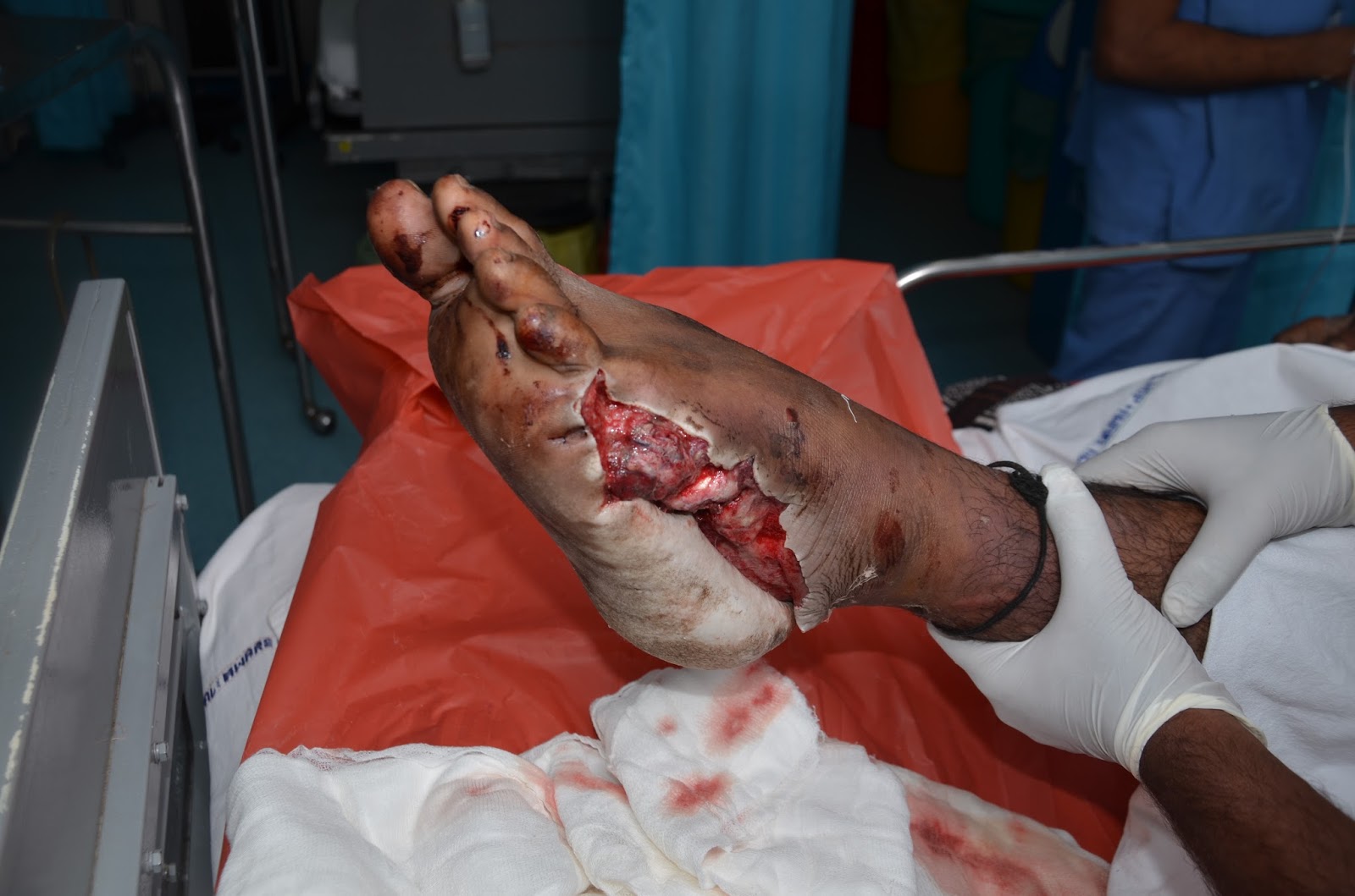 Circumferential degloving of the foot with lis franc joint dislocation. 