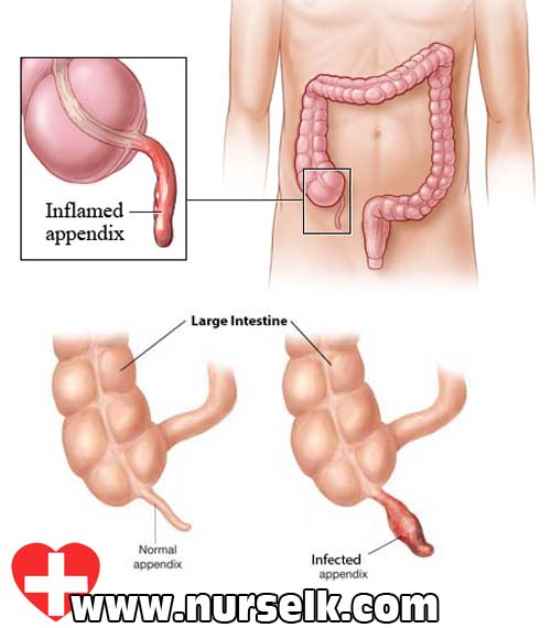 Appendicitis | Nurselk.com