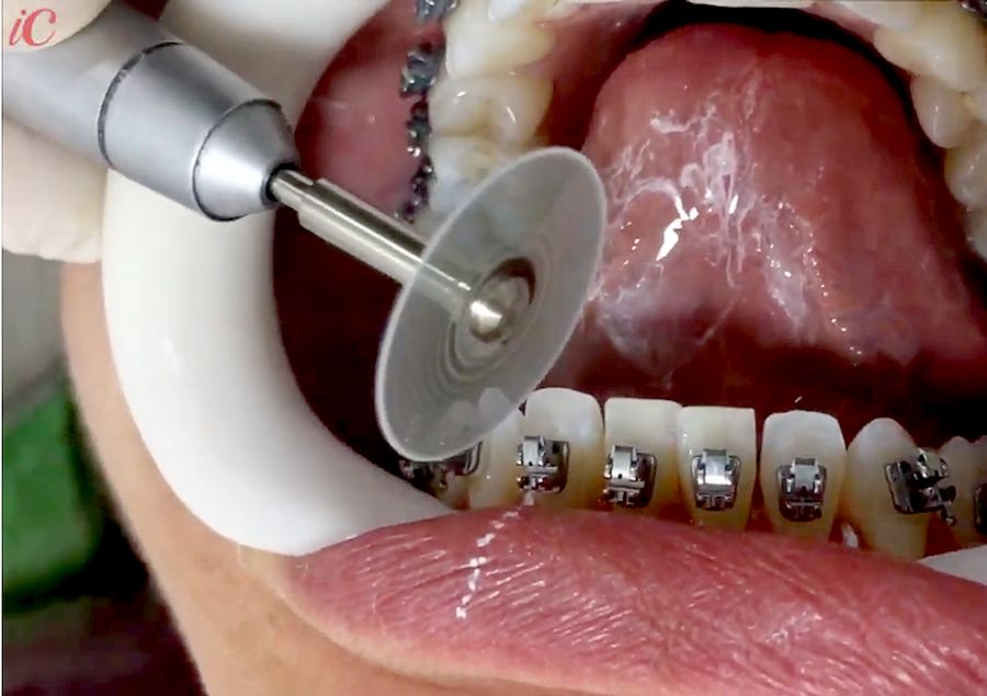 STRIPPING Desgaste Interproximal em Ortodontia OdontoTv